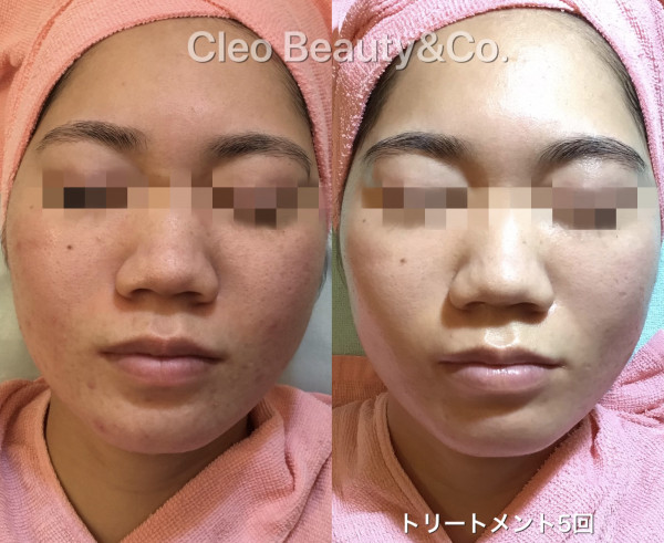 Cleo Beauty & Co.　西原店 | 水光艶肌ハーブトリートメント　モニター様