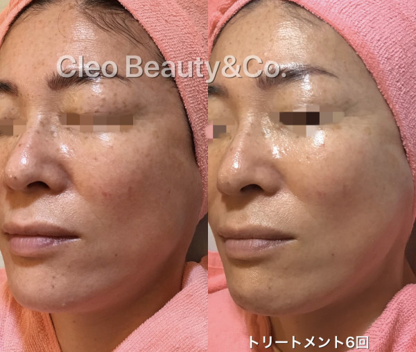 Cleo Beauty & Co.　西原店 | 水光艶肌ハーブトリートメント　モニター様