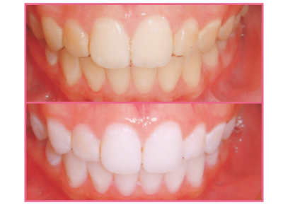 ハッピーデンタルクリニック | 白く輝く歯になりたい方おすすめ✨