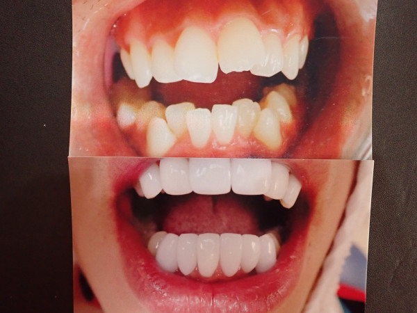 ハッピーデンタルクリニック | 歯の整形でこんなに変わるんです✨
