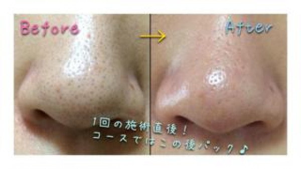 Beauty Salon プルメリア | 《１回でこの効果！》気になるブツブツ毛穴の黒ずみ撃退！