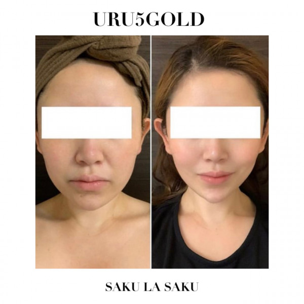 たるみ肌質改善専門サロン　SAKU LA SAKU | URU5GOLD　before→After