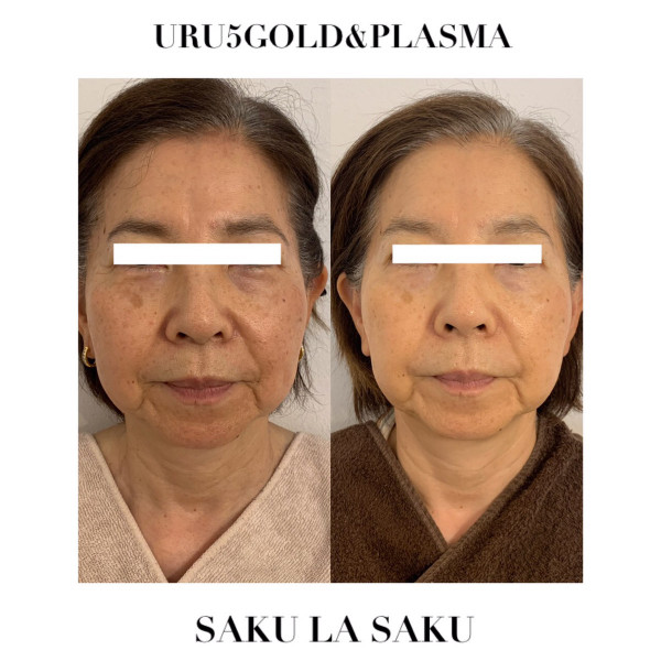 たるみ肌質改善専門サロン　SAKU LA SAKU | URU5GOLD＆プラズマゼノデュアル
