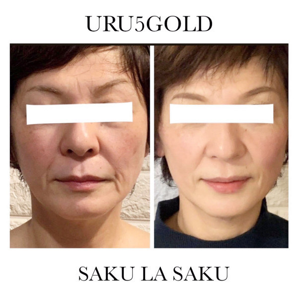 たるみ肌質改善専門サロン　SAKU LA SAKU | URU5GOLD