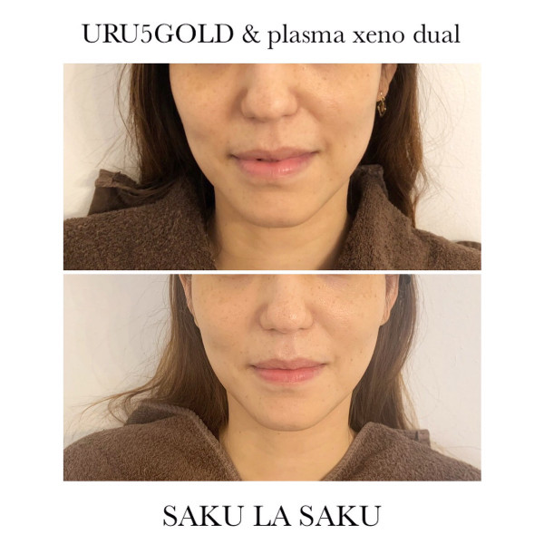 たるみ肌質改善専門サロン　SAKU LA SAKU | URU5GOLD＆プラズマゼノデュアル