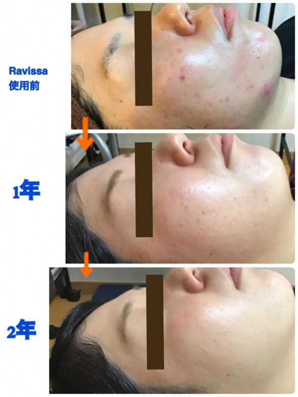 レイマージュ【女性整体・小顔矯正・体質改善】 | ravissaフェイシャルビフォーアフター