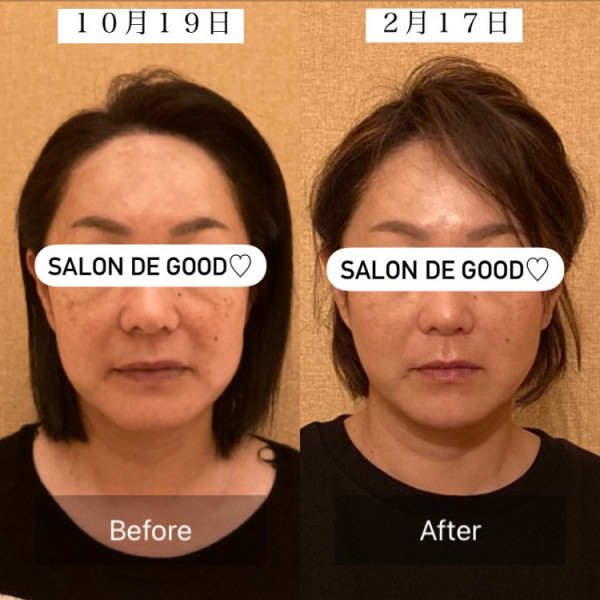 SALON  DE  GOOD  STYLE《都度払い痩身・ハイフ専門店》 | before→after