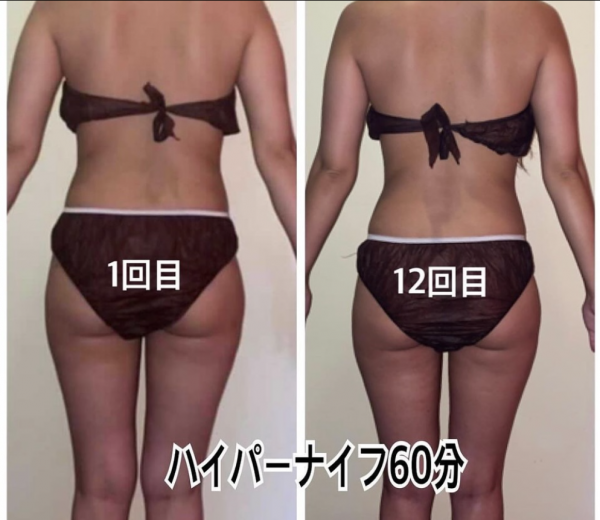 BODYエステサロン Y SHAPE | ハイパーナイフ