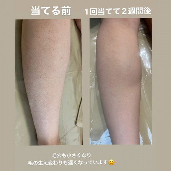 脱毛サロン LIEN | Before→After