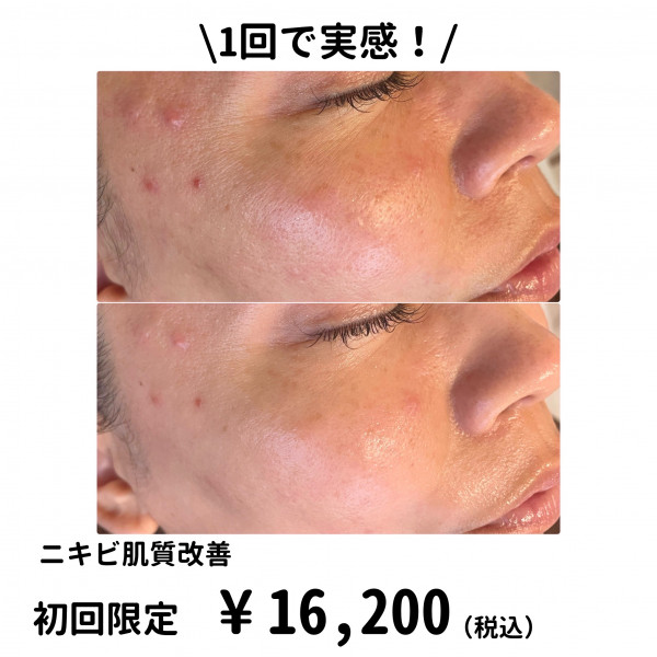 【シミ改善・ハーブピーリング・最新光美容機器】Bel Eclat | 毎月5名様限定！