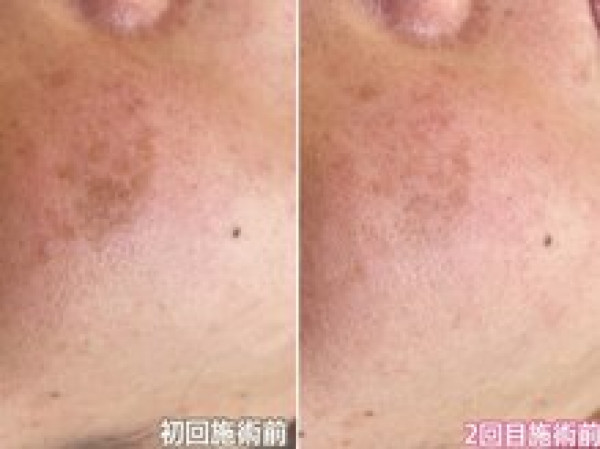 【シミ改善・ハーブピーリング・最新光美容機器】Bel Eclat | 