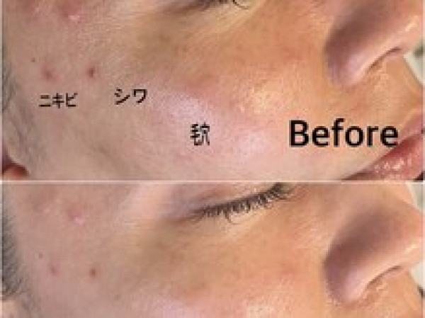 【シミ改善・ハーブピーリング・最新光美容機器】Bel Eclat | 