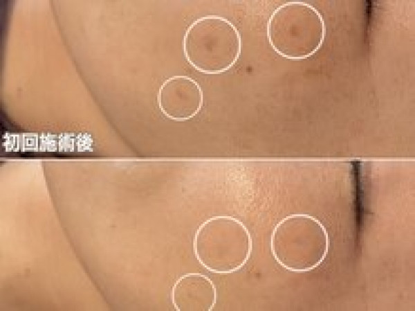 【シミ改善・ハーブピーリング・最新光美容機器】Bel Eclat | 