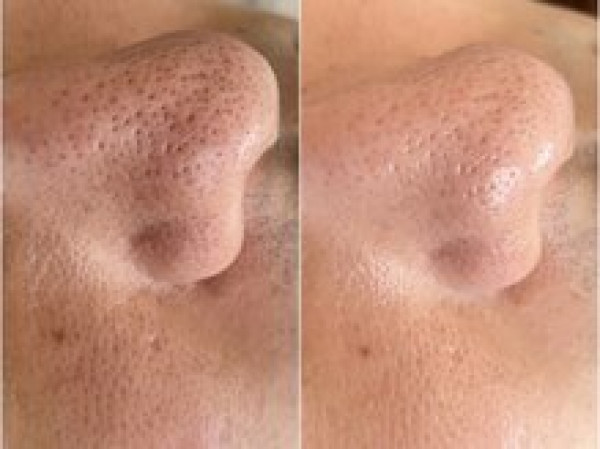 【シミ改善・ハーブピーリング・最新光美容機器】Bel Eclat | 