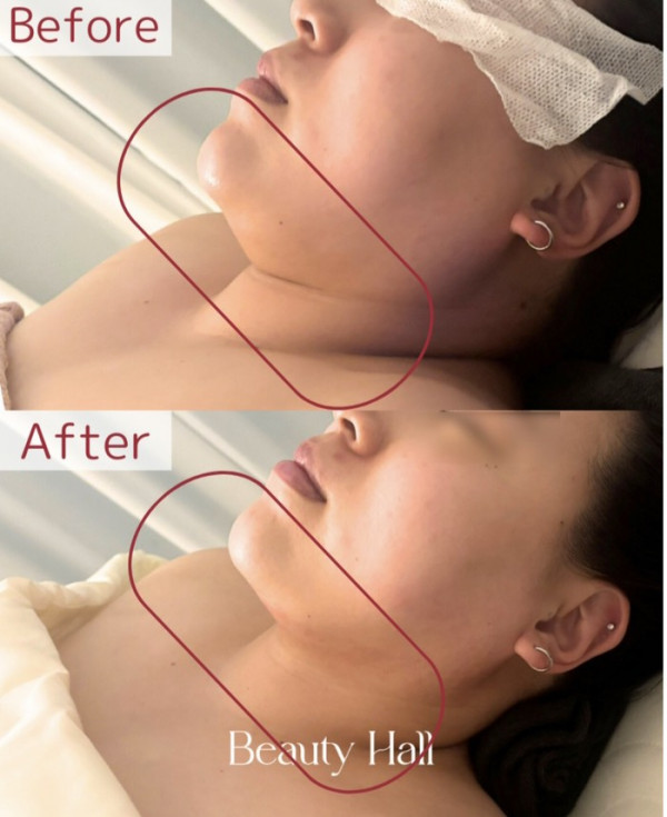 Bel Avenir | レッドショットフェイシャル ビフォーアフター