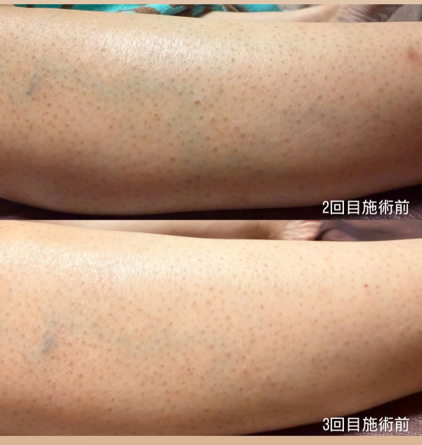 Churara | 脱毛Before→After