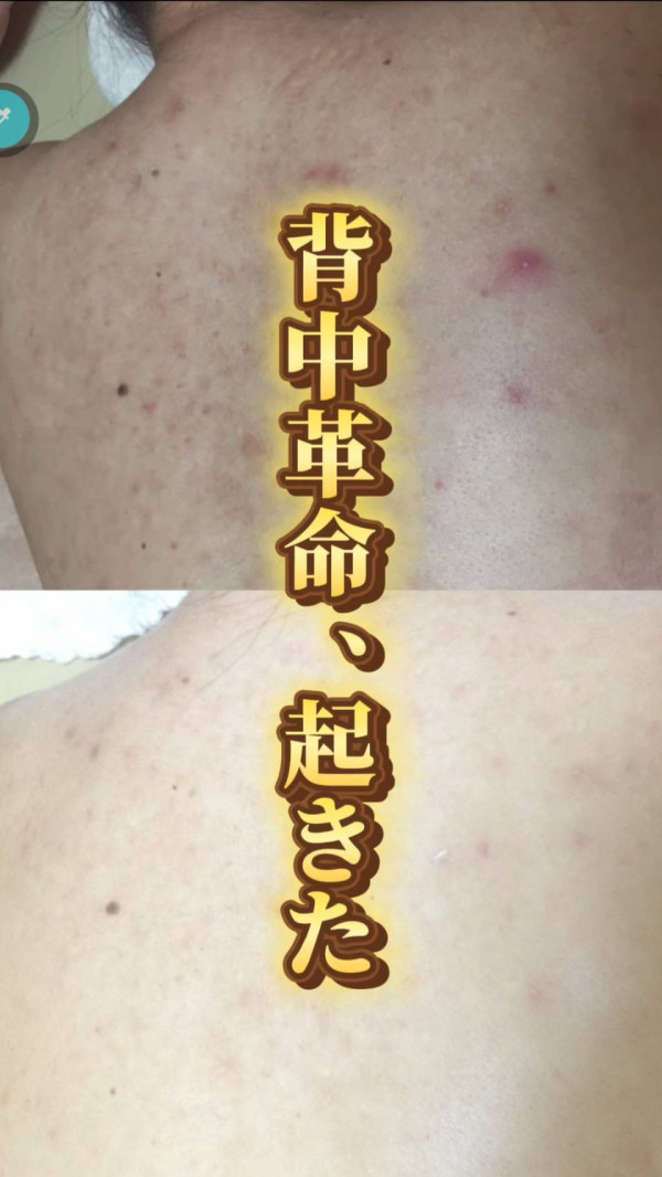 ホワイトピール　～肌質改善特化ハーブピーリング～ | 