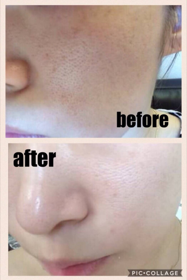 ホワイトピール　～肌質改善特化ハーブピーリング～ | 