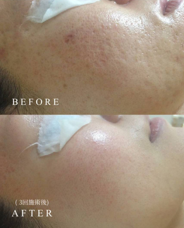 ホワイトピール　～肌質改善特化ハーブピーリング～ | 