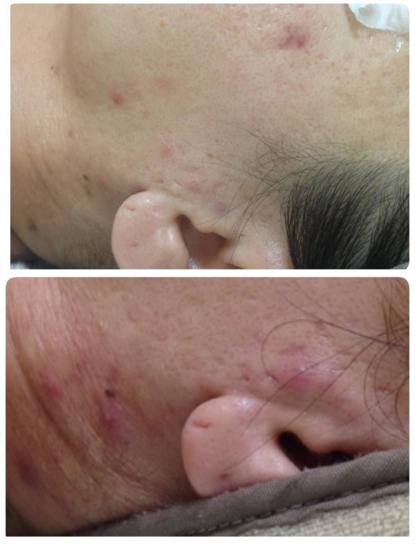 ホワイトピール　～肌質改善特化ハーブピーリング～ | 