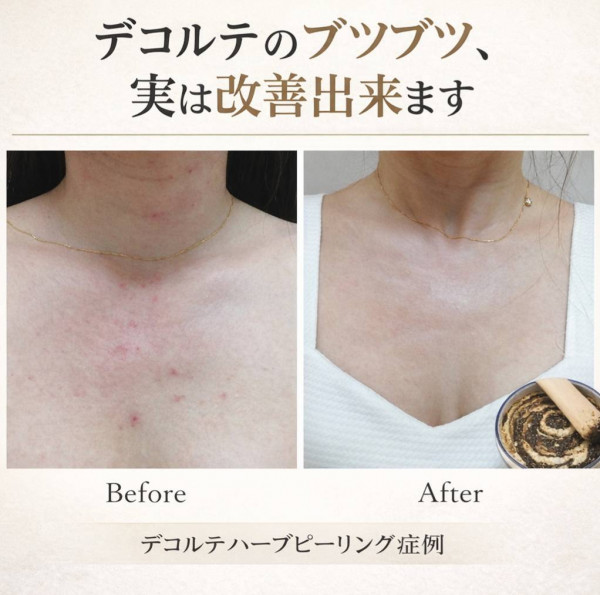 ホワイトピール　～肌質改善特化ハーブピーリング～ | 