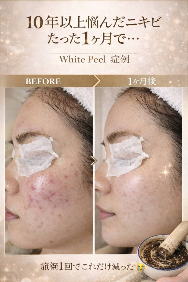 ホワイトピール　～肌質改善特化ハーブピーリング～ | 